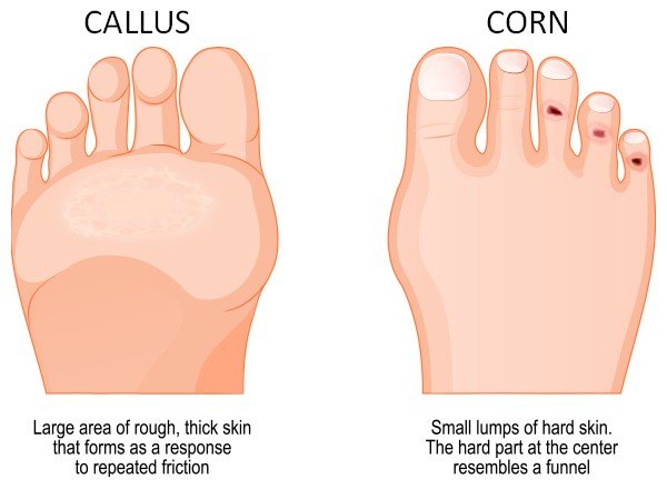 callus on foot sole and corns on toes