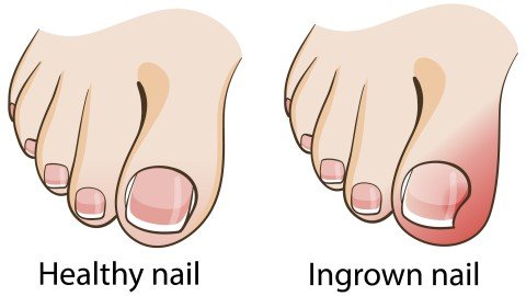 ingrown toenail