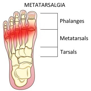 Metatarsalgia foot pain