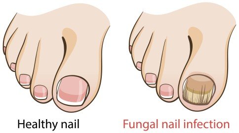 toenail fungus